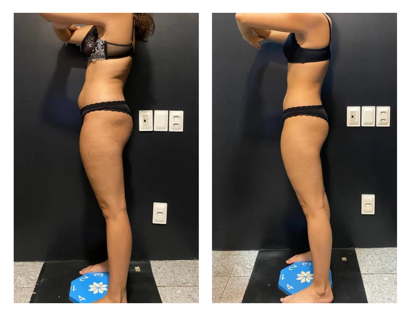 antes-e-depois-6-dr-diego-pascaretta-medico-nutrologo-especialista-em-saude-metaabolica-reposicao-hormonal-e-protocolos-personaizados-de-alta-performance- (1)