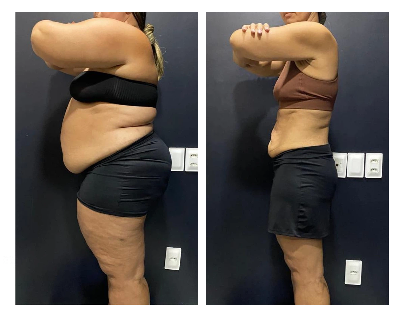 kaliny-suzany-antes-e-depois-9-dr-diego-pascaretta-medico-nutrologo-especialista-em-saude-metaabolica-reposicao-hormonal-e-protocolos-personaizados-de-alta-performance-